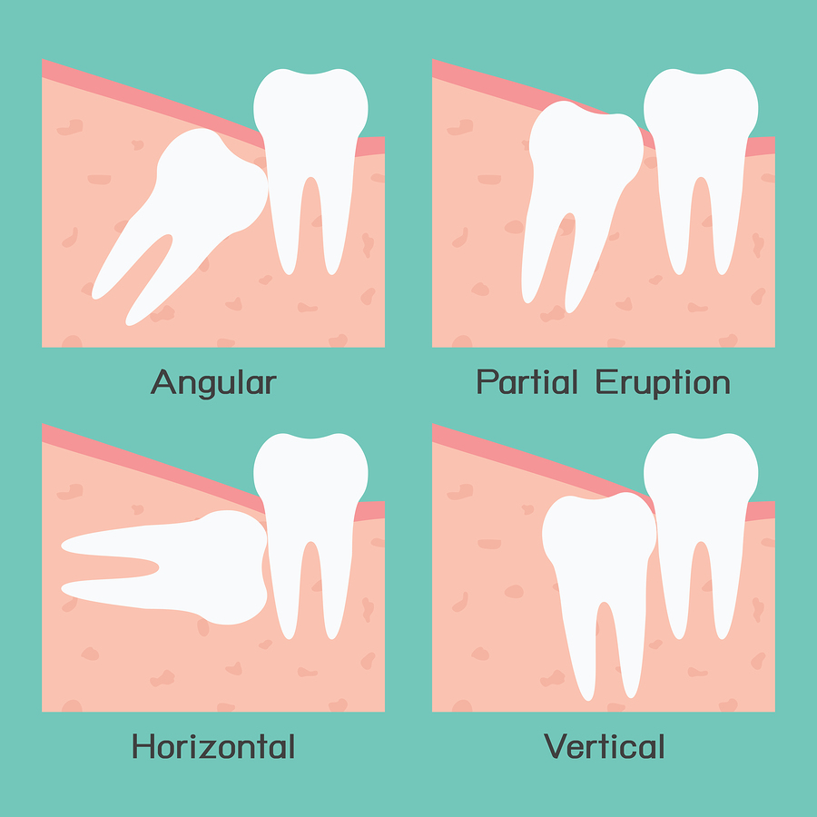 Illustration of the positions of wisdom teeth