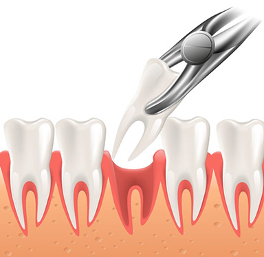 Illustration of tooth extraction - Mountain High Family Dental